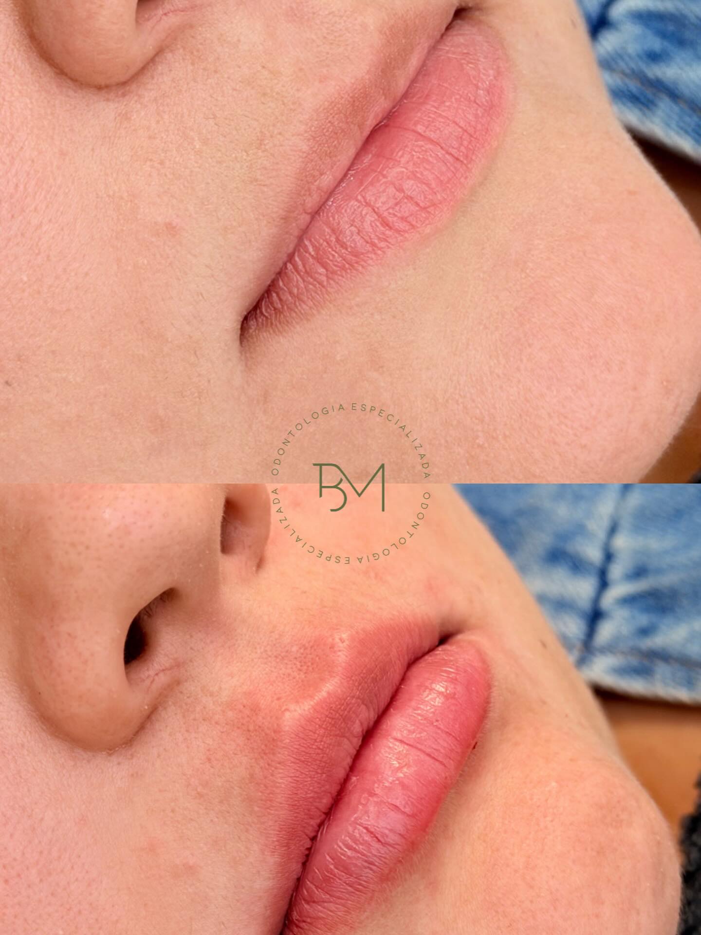 Antes e depois de procedimento de harmonização labial