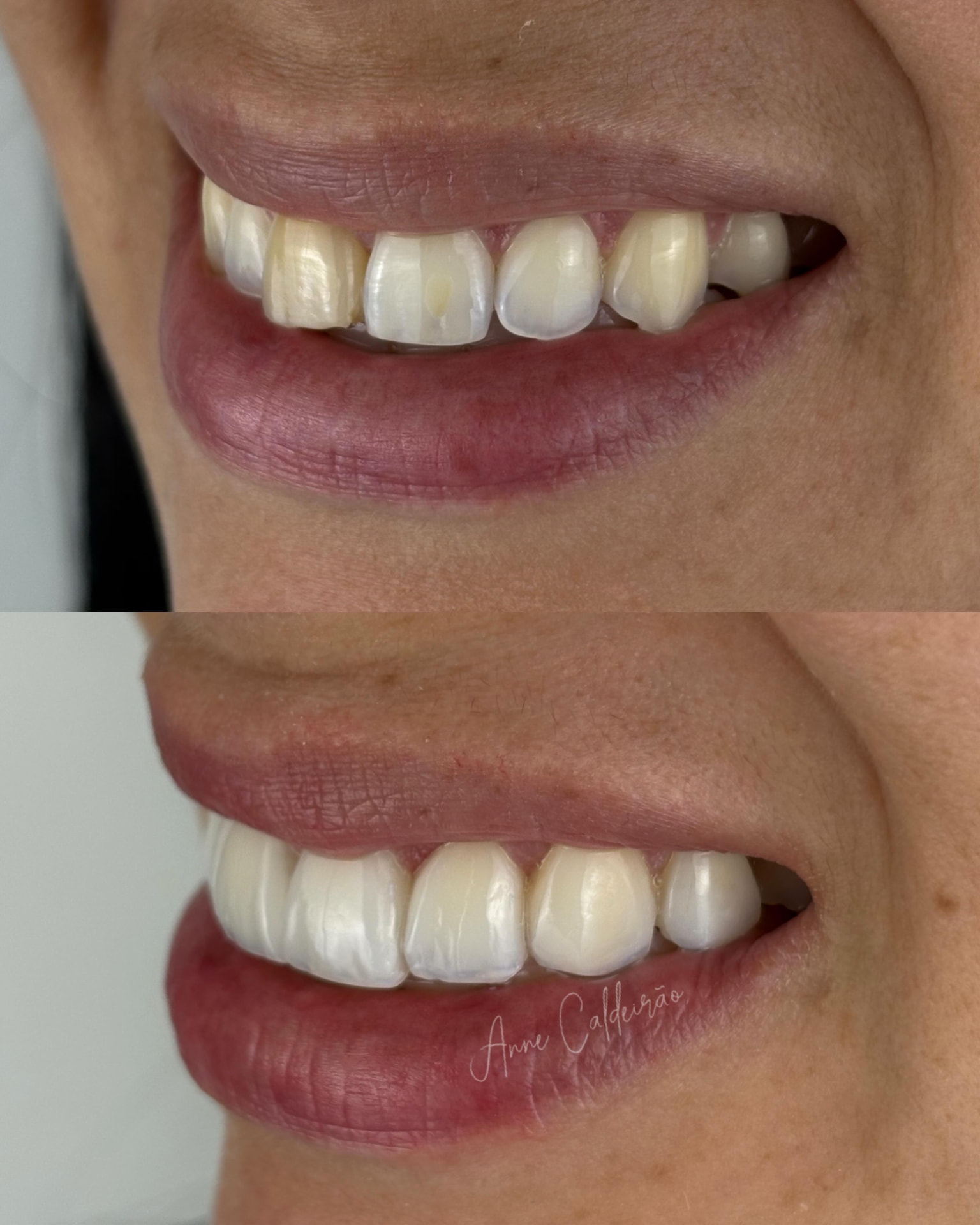 Antes e depois de tratamento estético dos dentes